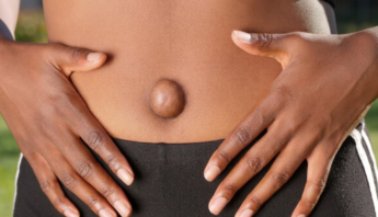 Tratamiento de la Hernia Umbilical: Opciones para la Recuperación
